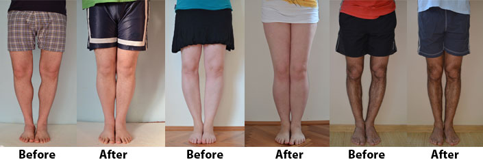 Bow Legs No More results before after